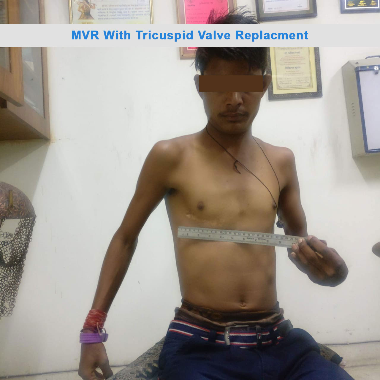 MVR - Mitral Valve Replacement surgical photo