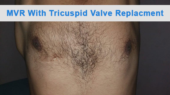 MVR - Mitral Valve Replacement surgical photo