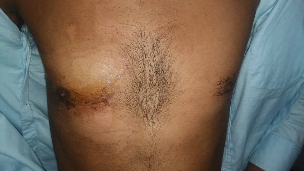 MVR - Mitral Valve Replacement surgical photo