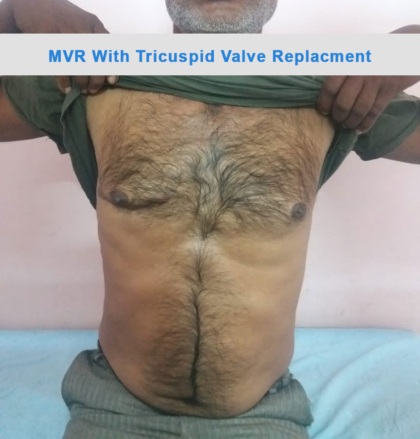 MVR - Mitral Valve Replacement surgical photo