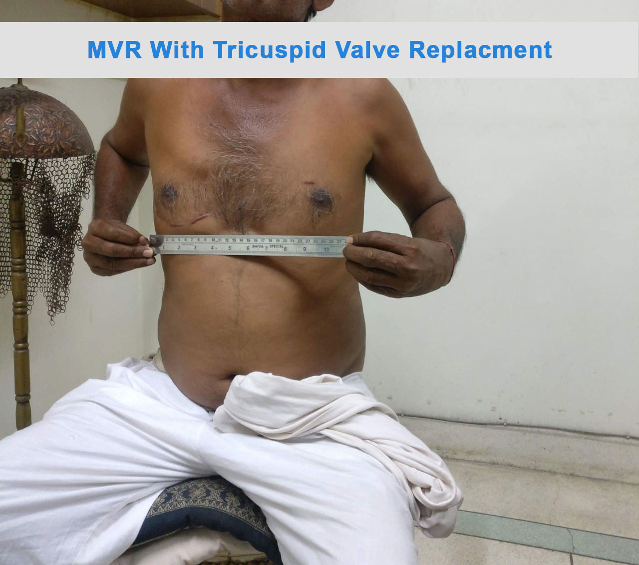 MVR - Mitral Valve Replacement surgical photo