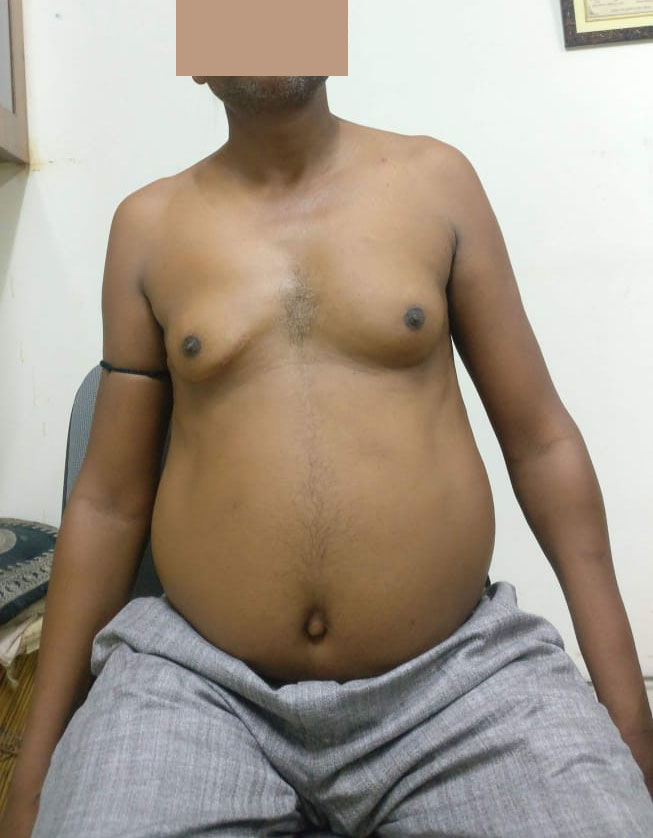 MVR - Mitral Valve Replacement surgical photo