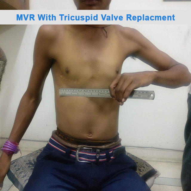 MVR - Mitral Valve Replacement surgical photo