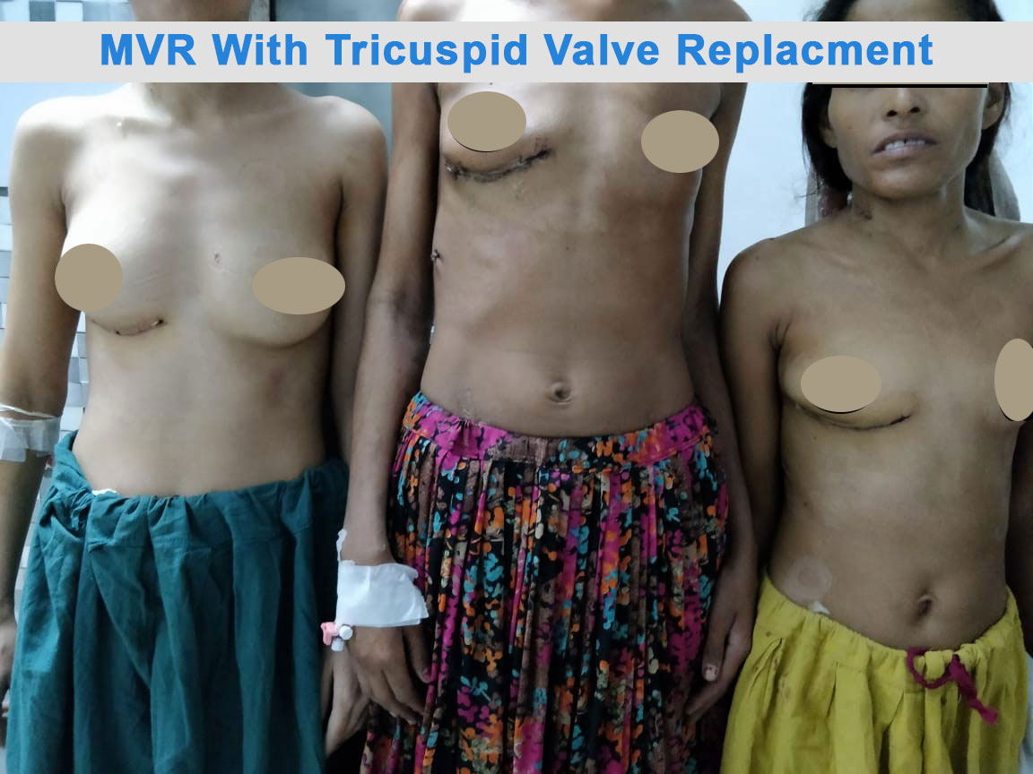 MVR - Mitral Valve Replacement surgical photo