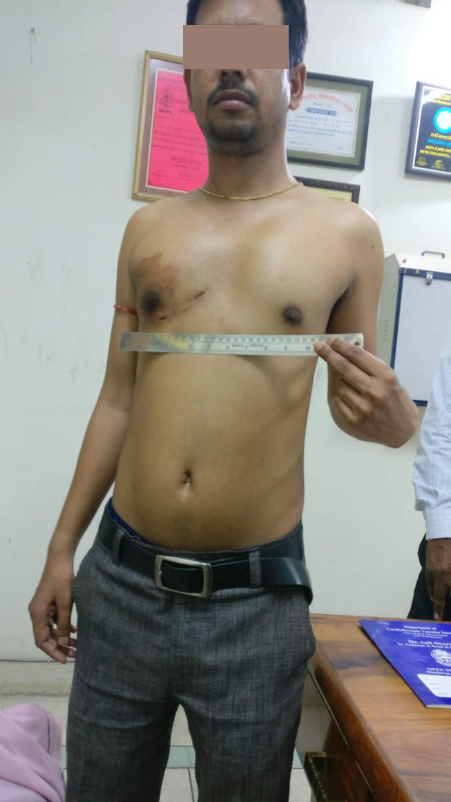 MVR - Mitral Valve Replacement surgical photo