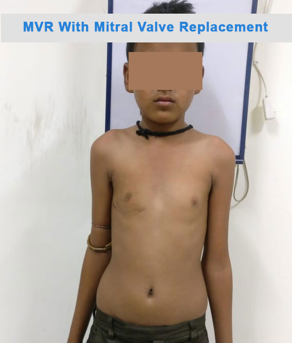 MVR - Mitral Valve Replacement surgical photo