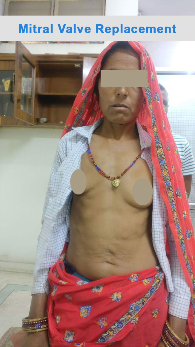 MVR - Mitral Valve Replacement surgical photo