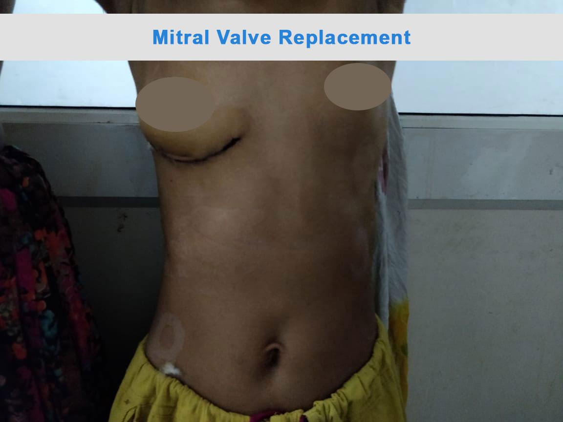 MVR - Mitral Valve Replacement surgical photo