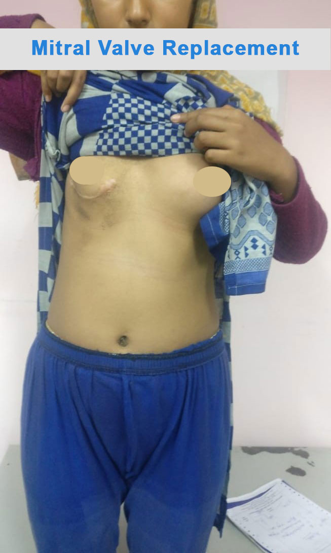 MVR - Mitral Valve Replacement surgical photo