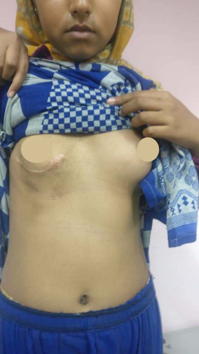 MVR - Mitral Valve Replacement surgical photo