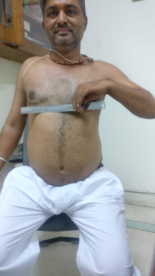 MVR - Mitral Valve Replacement surgical photo