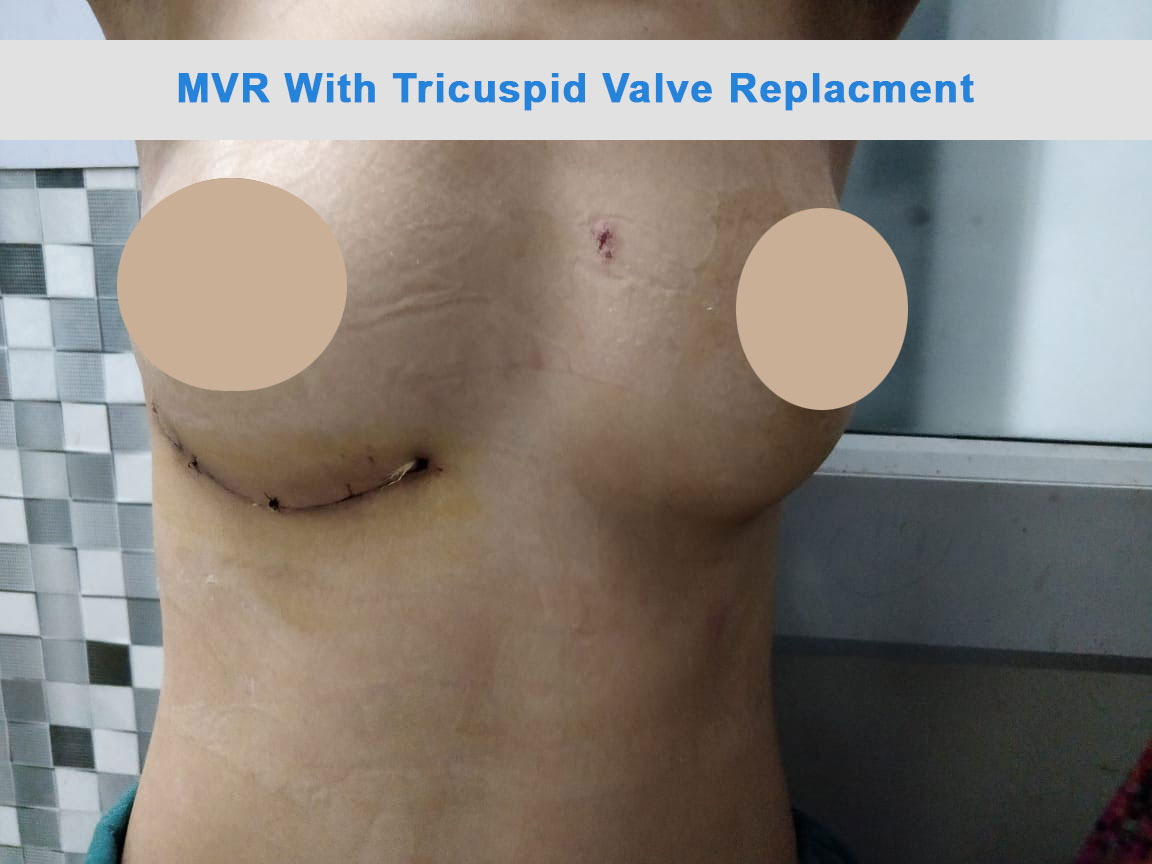 MVR - Mitral Valve Replacement surgical photo