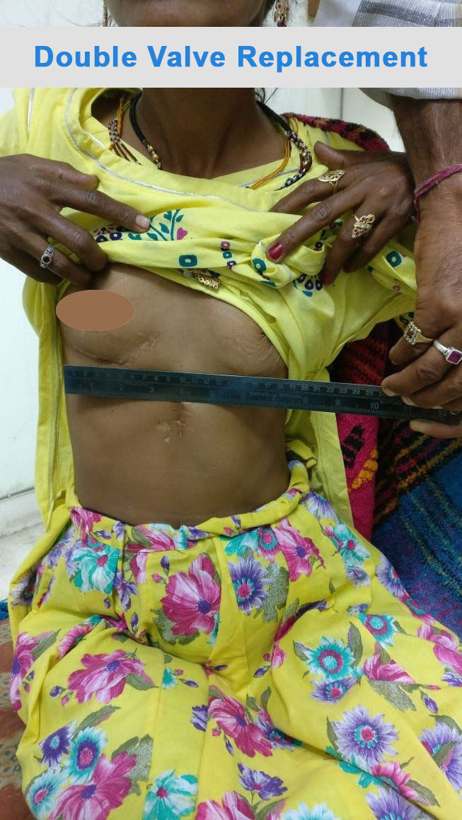 MVR - Mitral Valve Replacement surgical photo