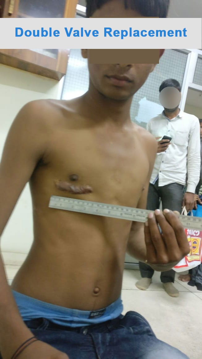 MVR - Mitral Valve Replacement surgical photo