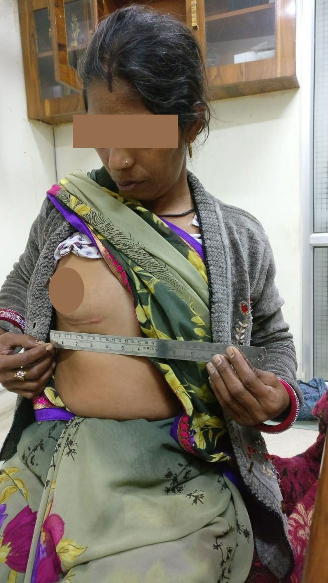 MVR - Mitral Valve Replacement surgical photo