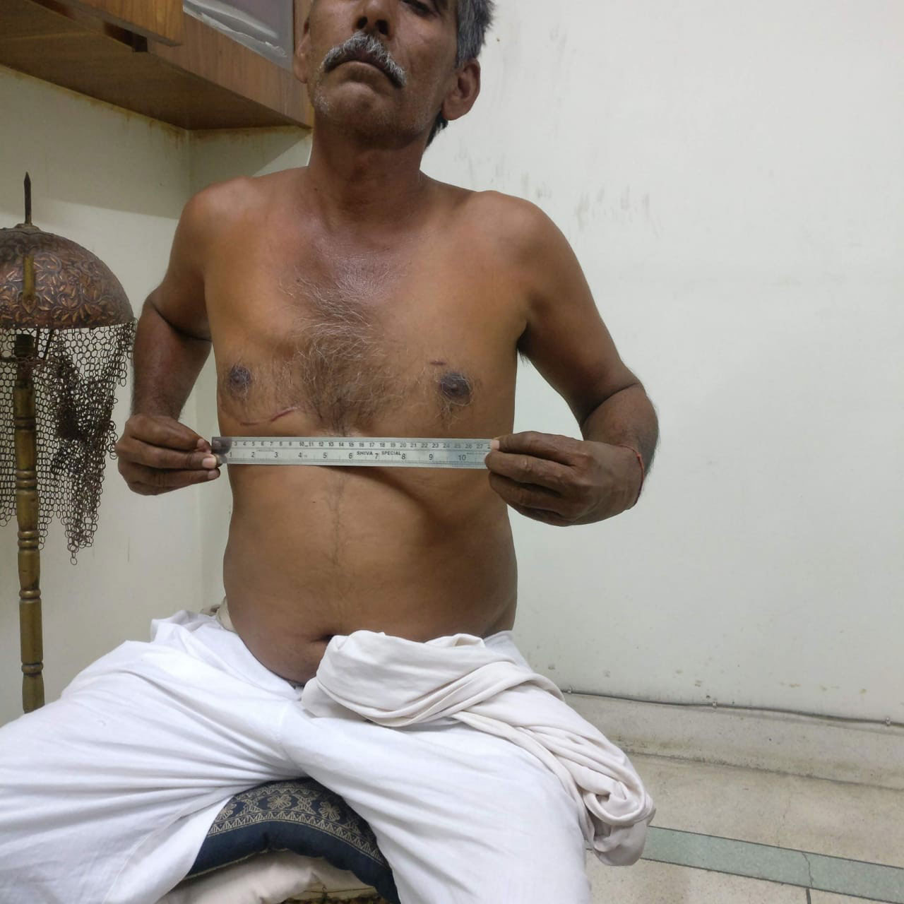 MVR - Mitral Valve Replacement surgical photo