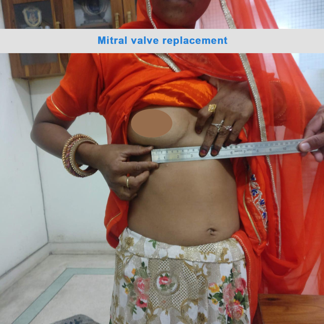 MVR - Mitral Valve Replacement surgical photo