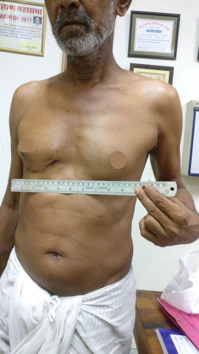 MVR - Mitral Valve Replacement surgical photo