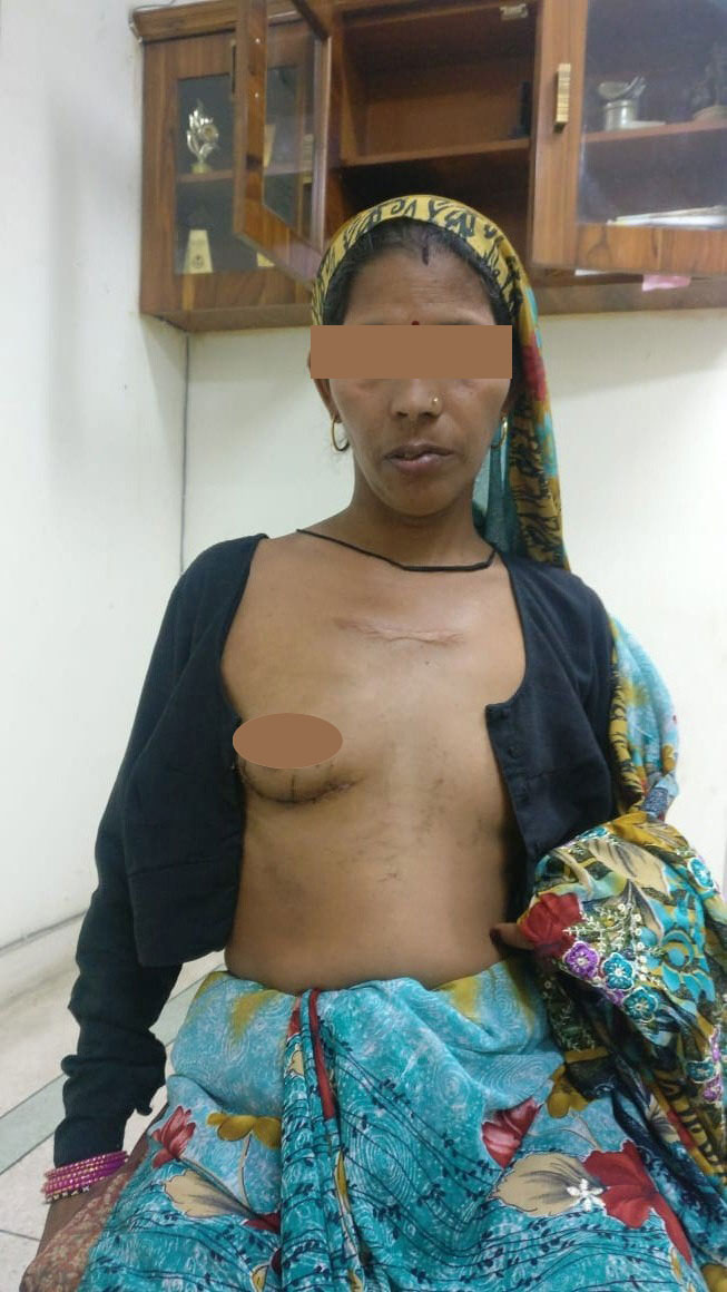 MVR - Mitral Valve Replacement surgical photo