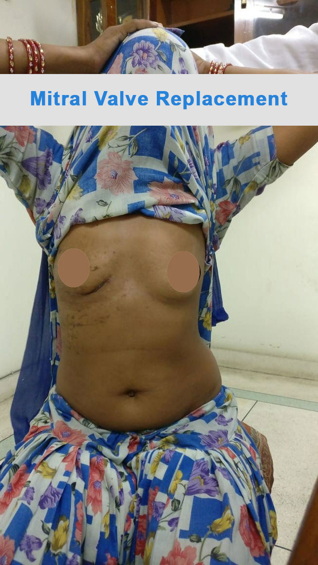 MVR - Mitral Valve Replacement surgical photo