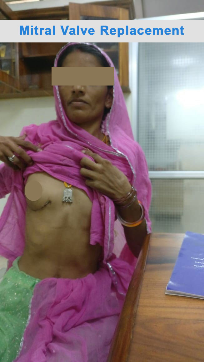 MVR - Mitral Valve Replacement surgical photo