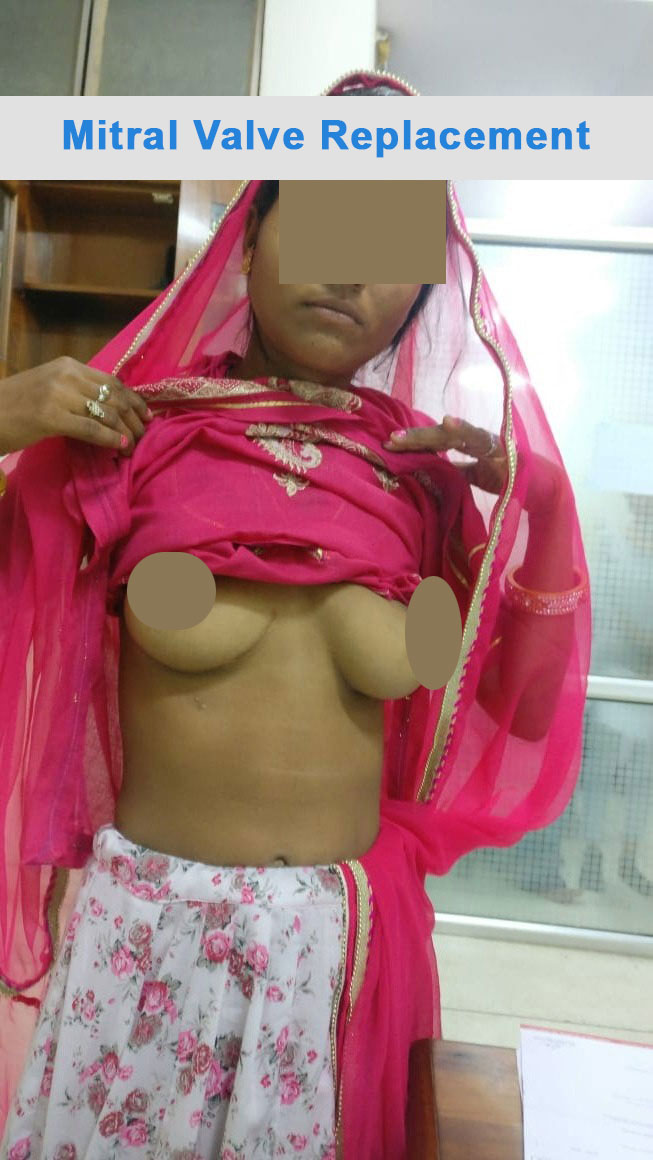 MVR - Mitral Valve Replacement surgical photo