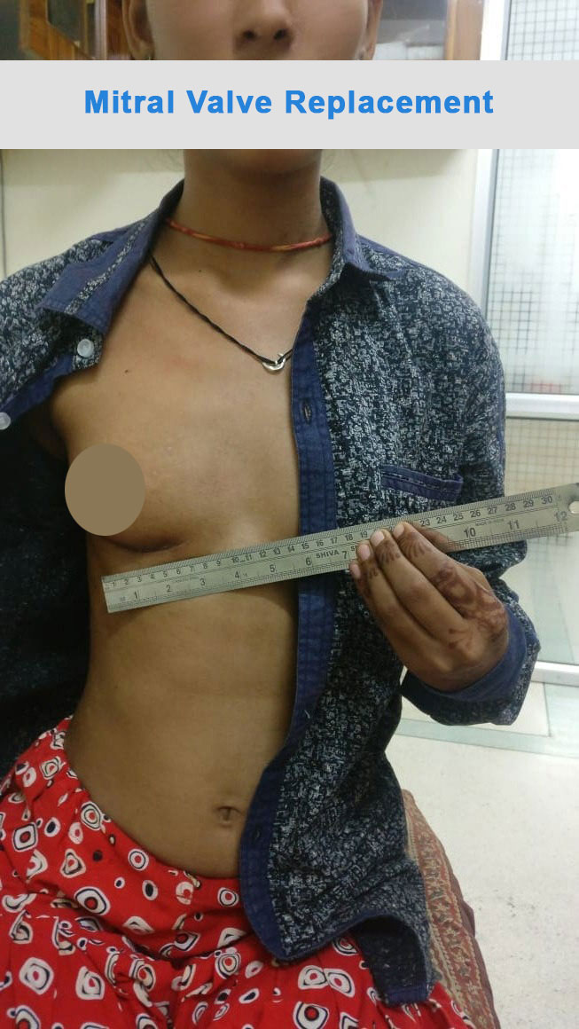 MVR - Mitral Valve Replacement surgical photo