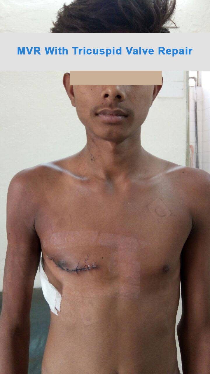 MVR - Mitral Valve Replacement surgical photo