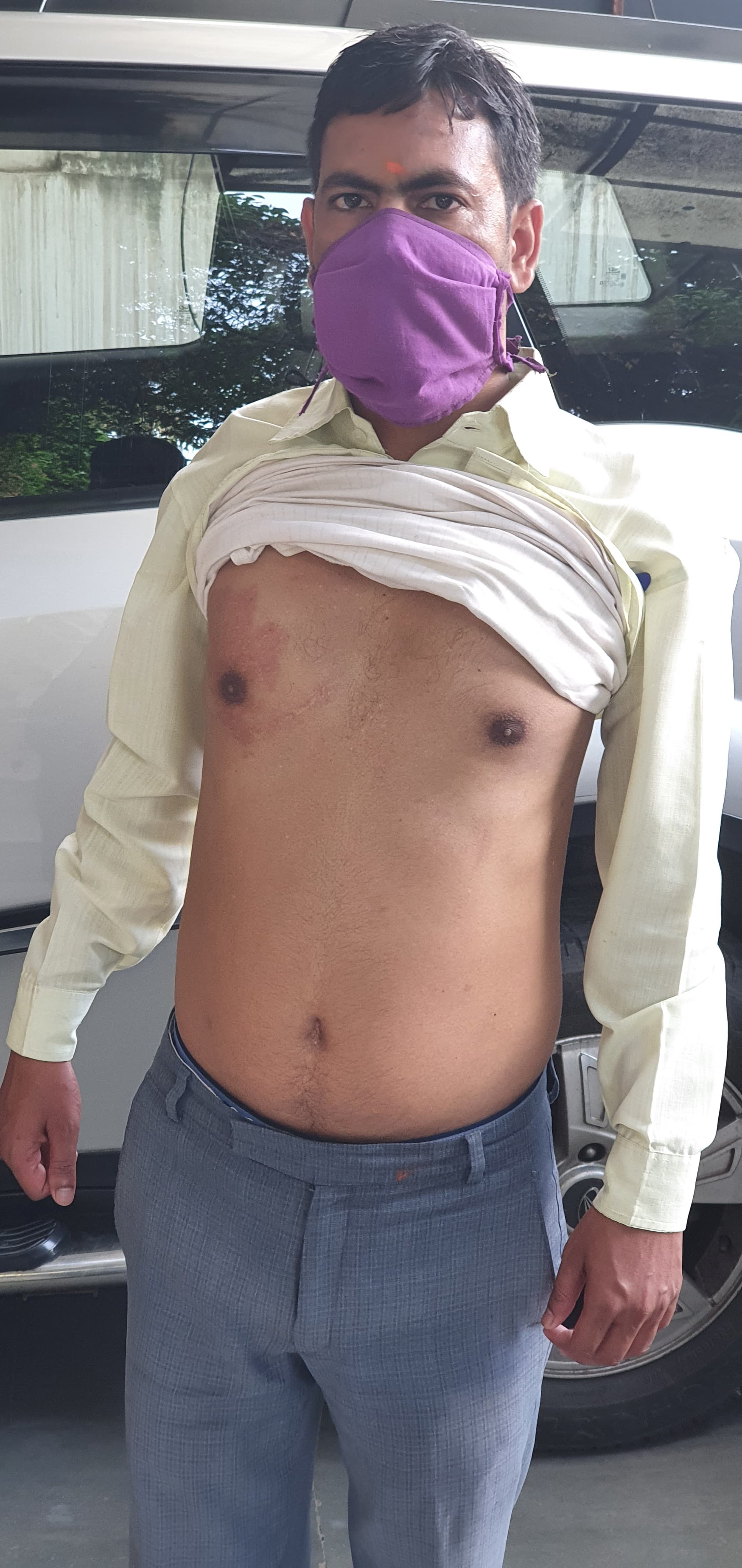 MVR - Mitral Valve Replacement surgical photo