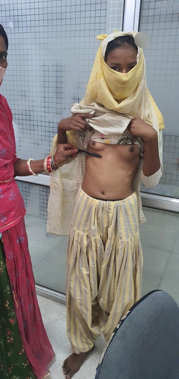 MVR - Mitral Valve Replacement surgical photo