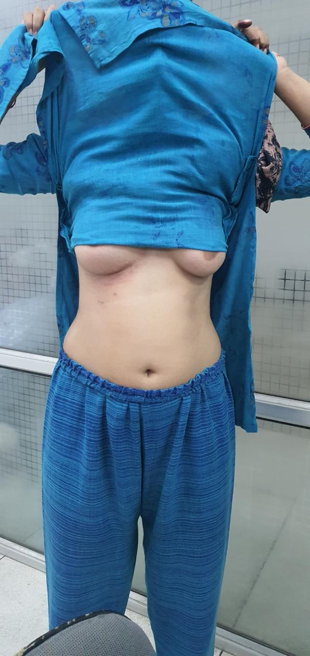 MVR - Mitral Valve Replacement surgical photo