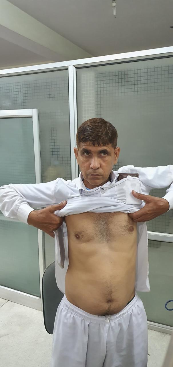 MVR - Mitral Valve Replacement surgical photo