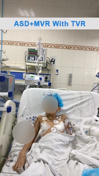 TOF - Tetralogy of Fallot surgical photo