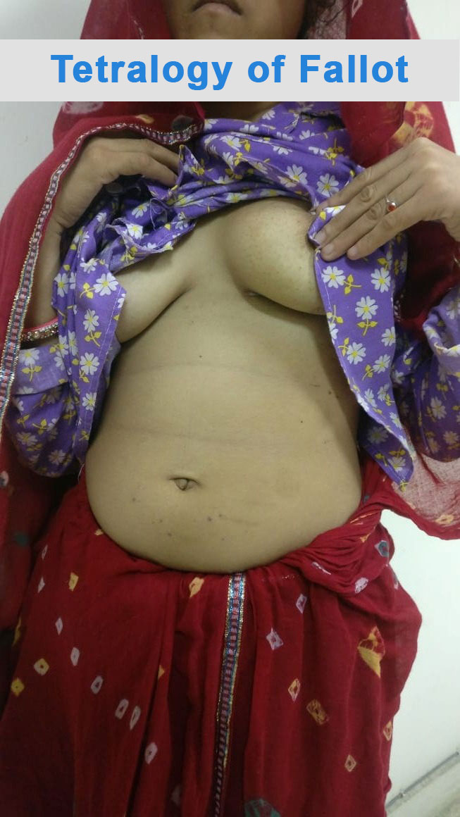 TOF - Tetralogy of Fallot surgical photo