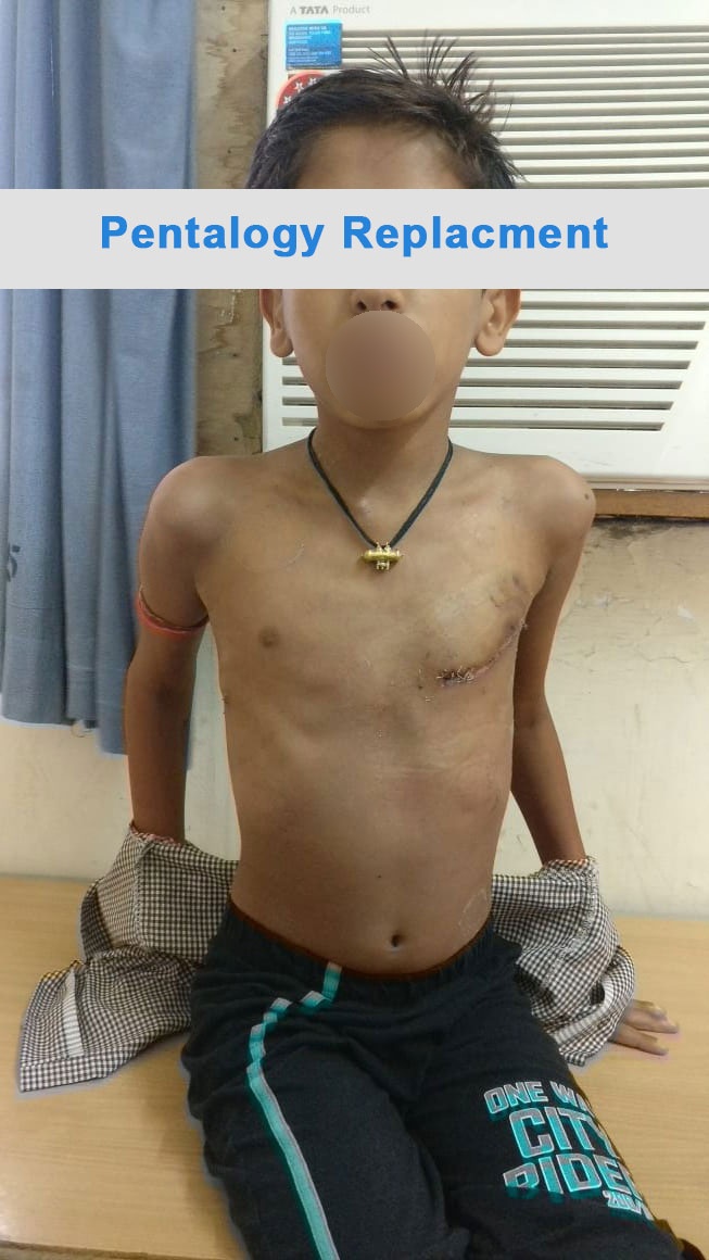 TOF - Tetralogy of Fallot surgical photo