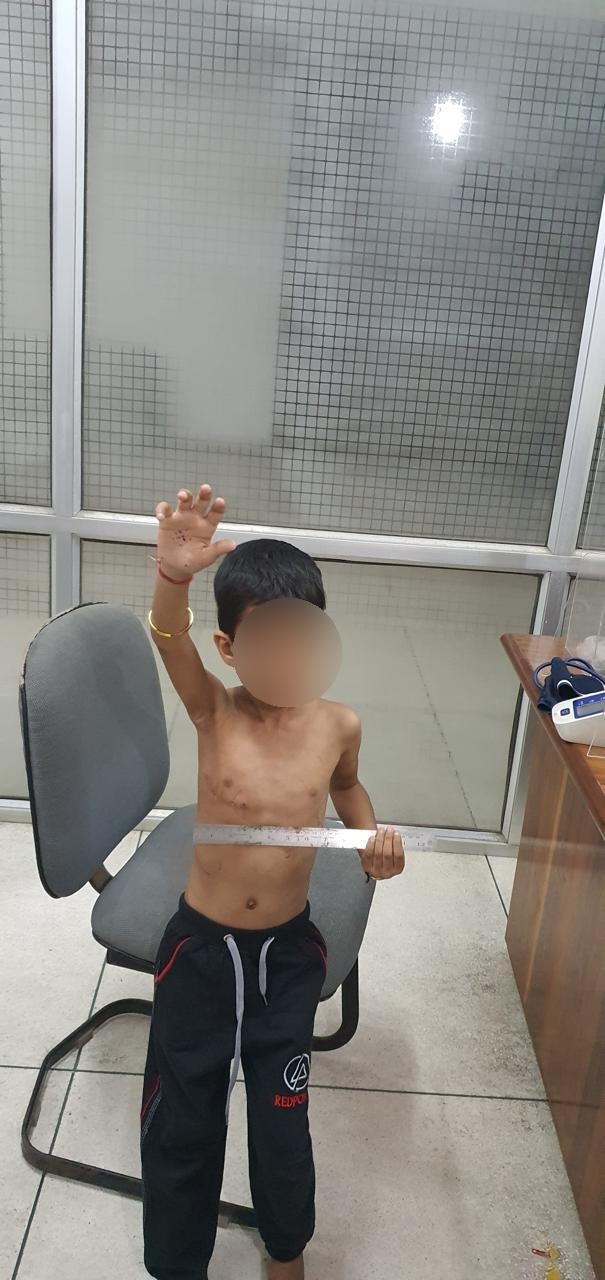 VSD - Ventricular Septal Defect surgical photo